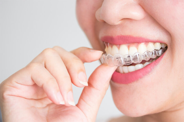 All You Need To Know About Invisalign And Braces