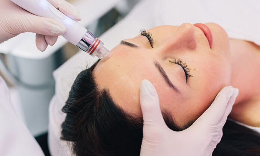 Microneedling vs Other Skin Treatments: Which Is Right for You?
